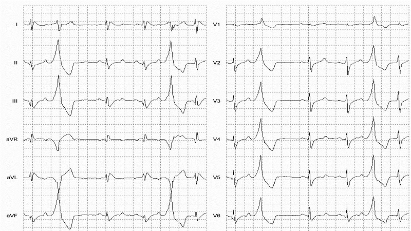 Ventricular trigeminy 12 Lead EKG